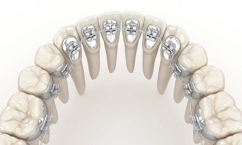 video LingoBraces Cost, Pros & Cons