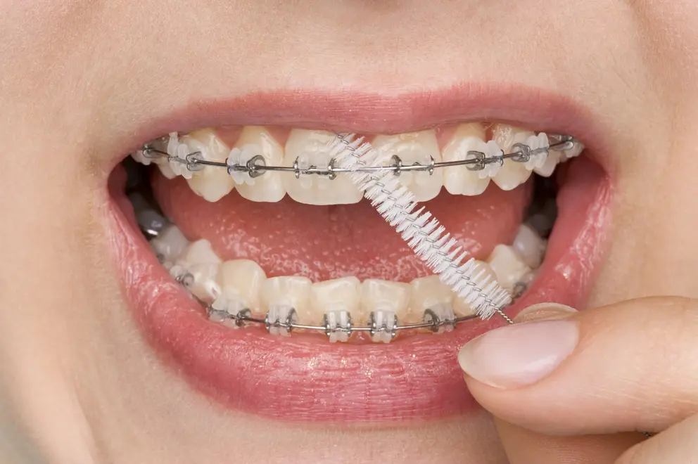 WHAT ARE  Ceramic Braces Made Of