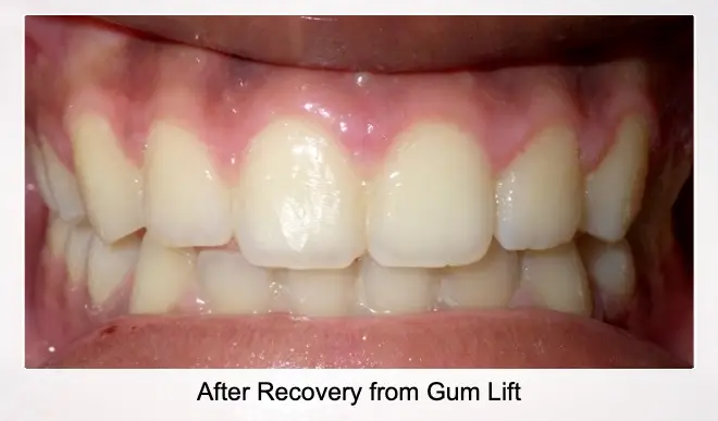 Mouth After Recovering From Gum Lift
