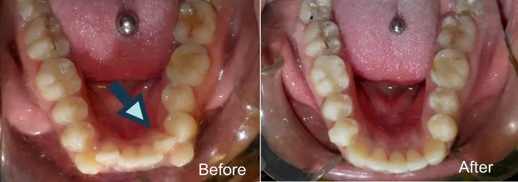 Alonda  years old lower front crowding removal of lower incisor and  months Invisalign treatment before and after