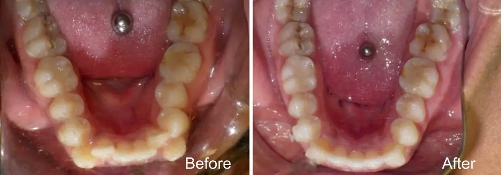 Alonda  years old lower incisor extraction case with Invisalign treatment