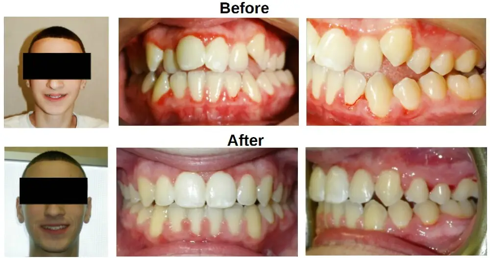 Anthony Metal Braces Before and After