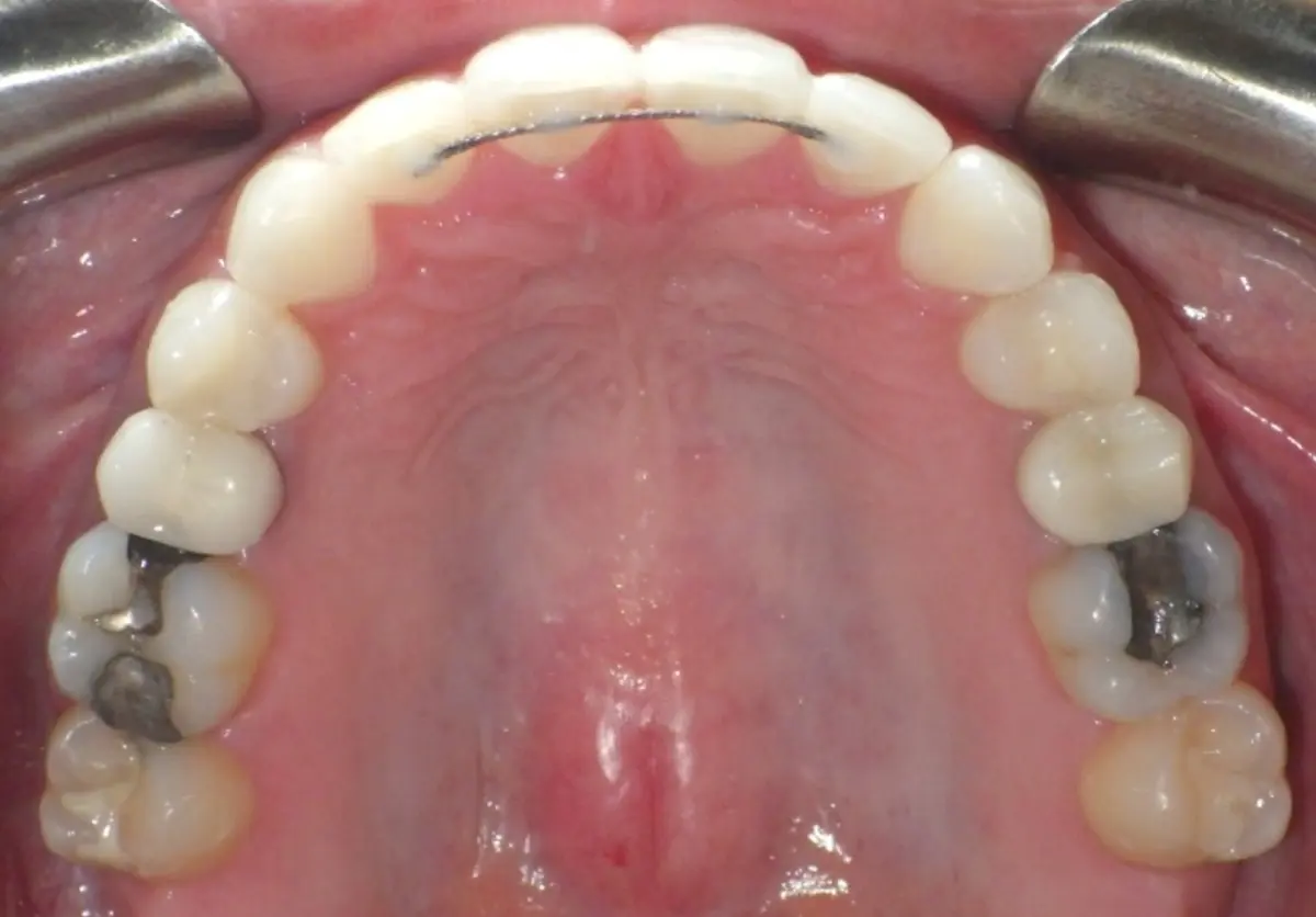 Orthodontic Retainers Types, Cost, Pros and Cons, Care