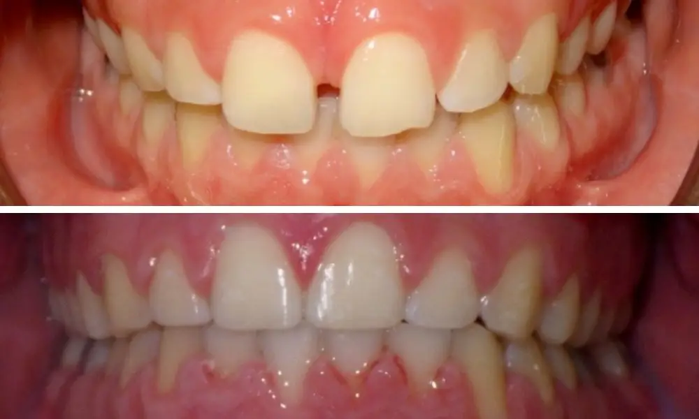 BRACES TREATMENTS,  Before and After