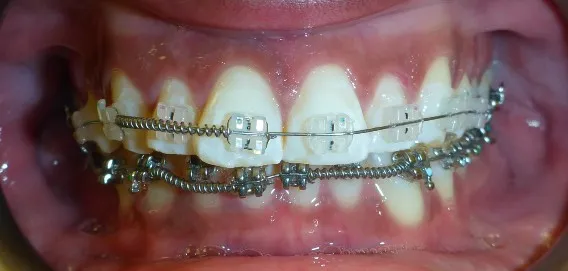 CERAMIC BRACES:  Results You Can See from Treatment You Can’t