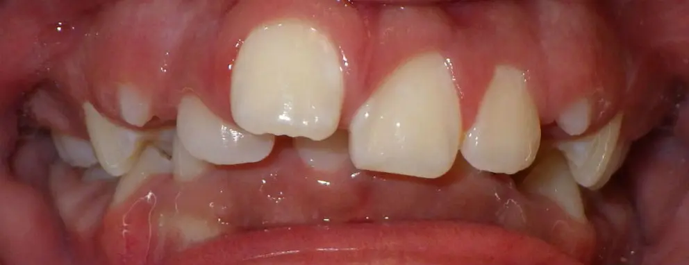 CAN  Invisalign Aligners Correct Crowding