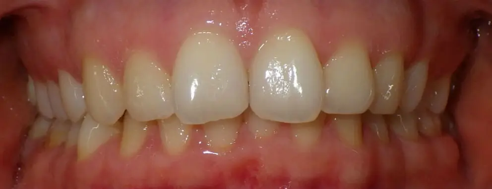 CAN A  Hawley Retainer Correct Overbite