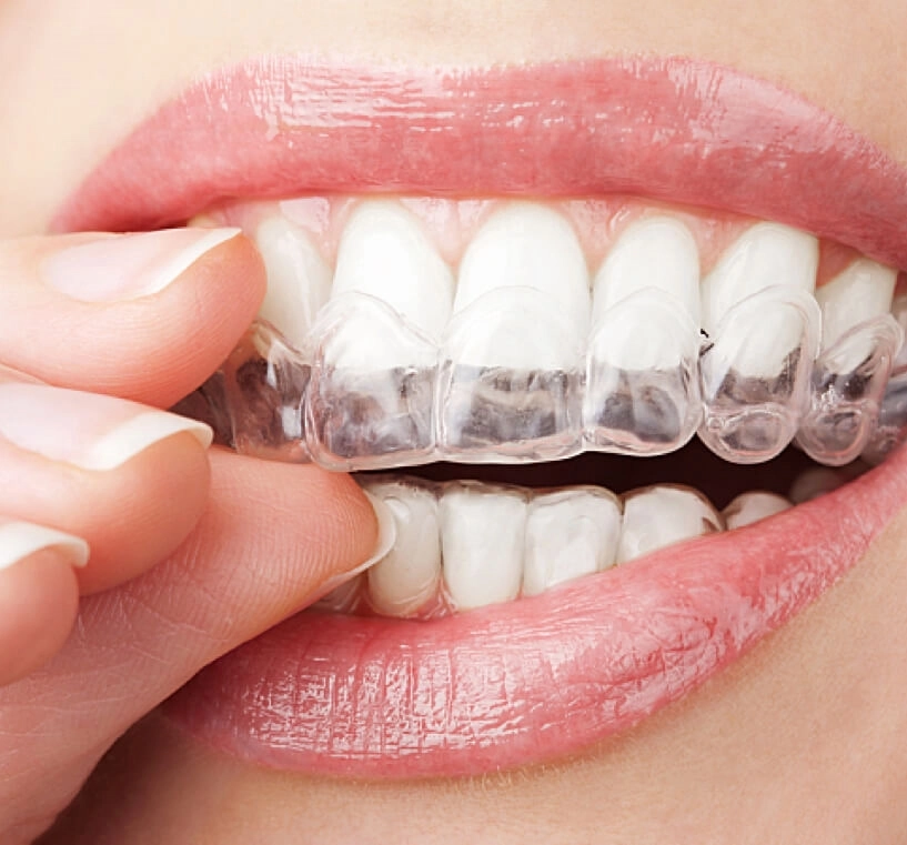 Invisalign Adults Diamond Braces Sheepshead Bay Brooklyn NY