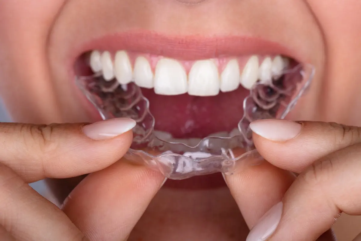 Invisalign Attachments - Manhattan Bridge Orthodontics