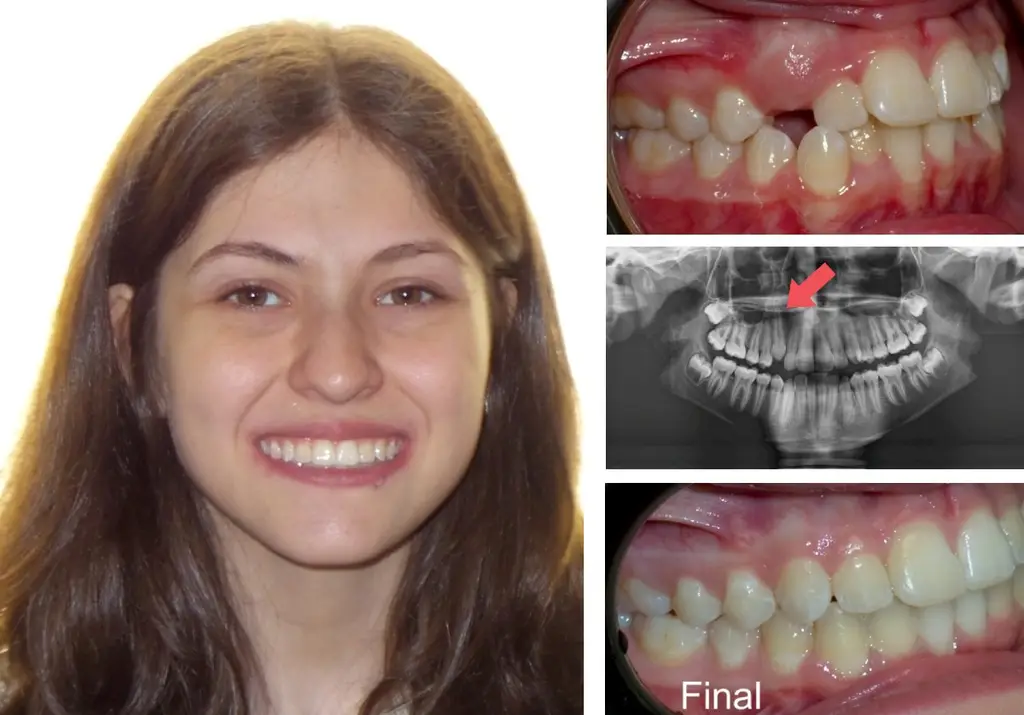Female  Years Old with Impacted Teeth Before and After Treatment