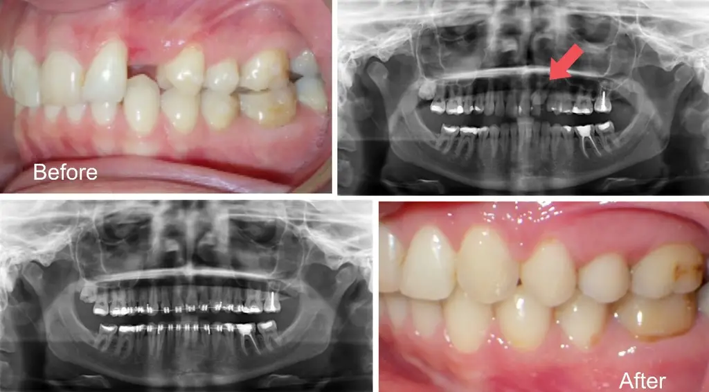 Mujer de 29 años con dientes impactados antes y después del tratamiento con brackets