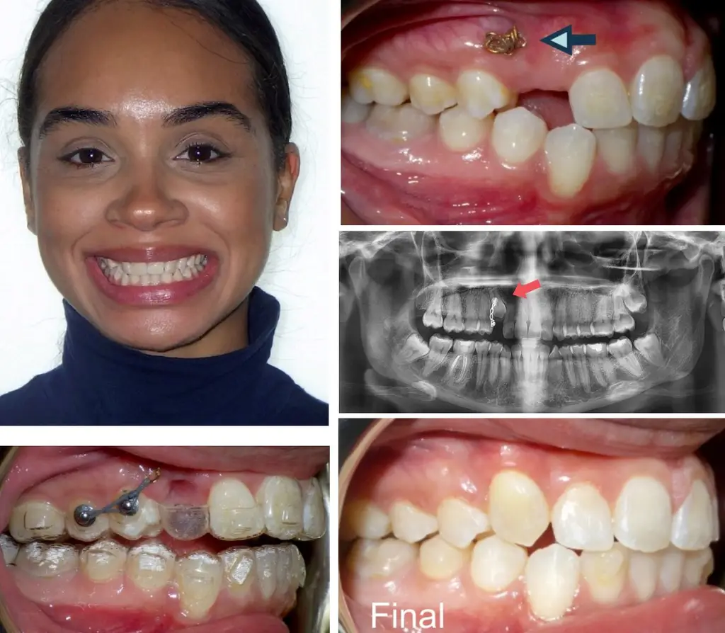 Mujer de 30 años con dientes impactados antes y después del tratamiento con Invisalign