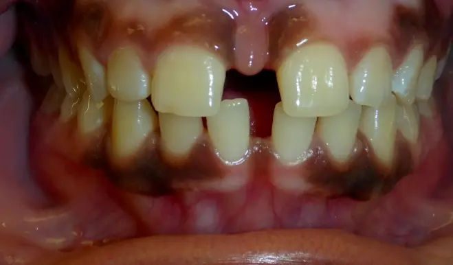 Gingivectomy Braces Before