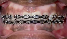 Gingivectomy Braces PriorToGingivectomy