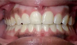 Gingivectomy BracesAfterGingivectomy