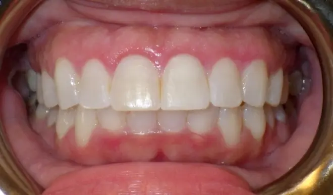 Healed gum line