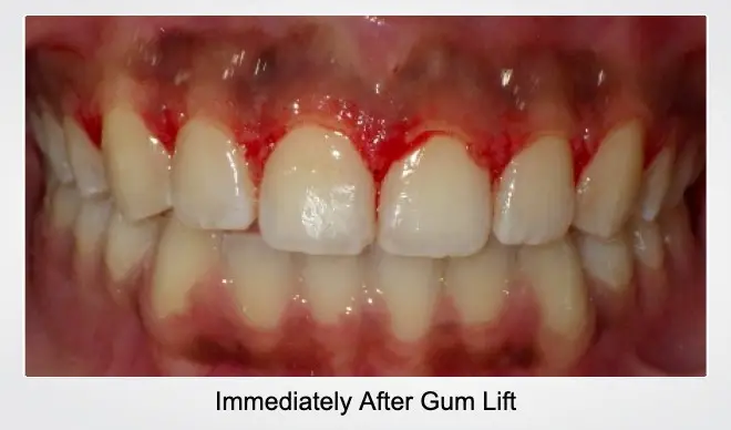 Immediately After Gum Lift