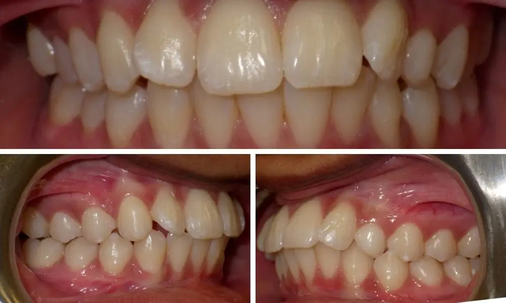 Braces Before and After