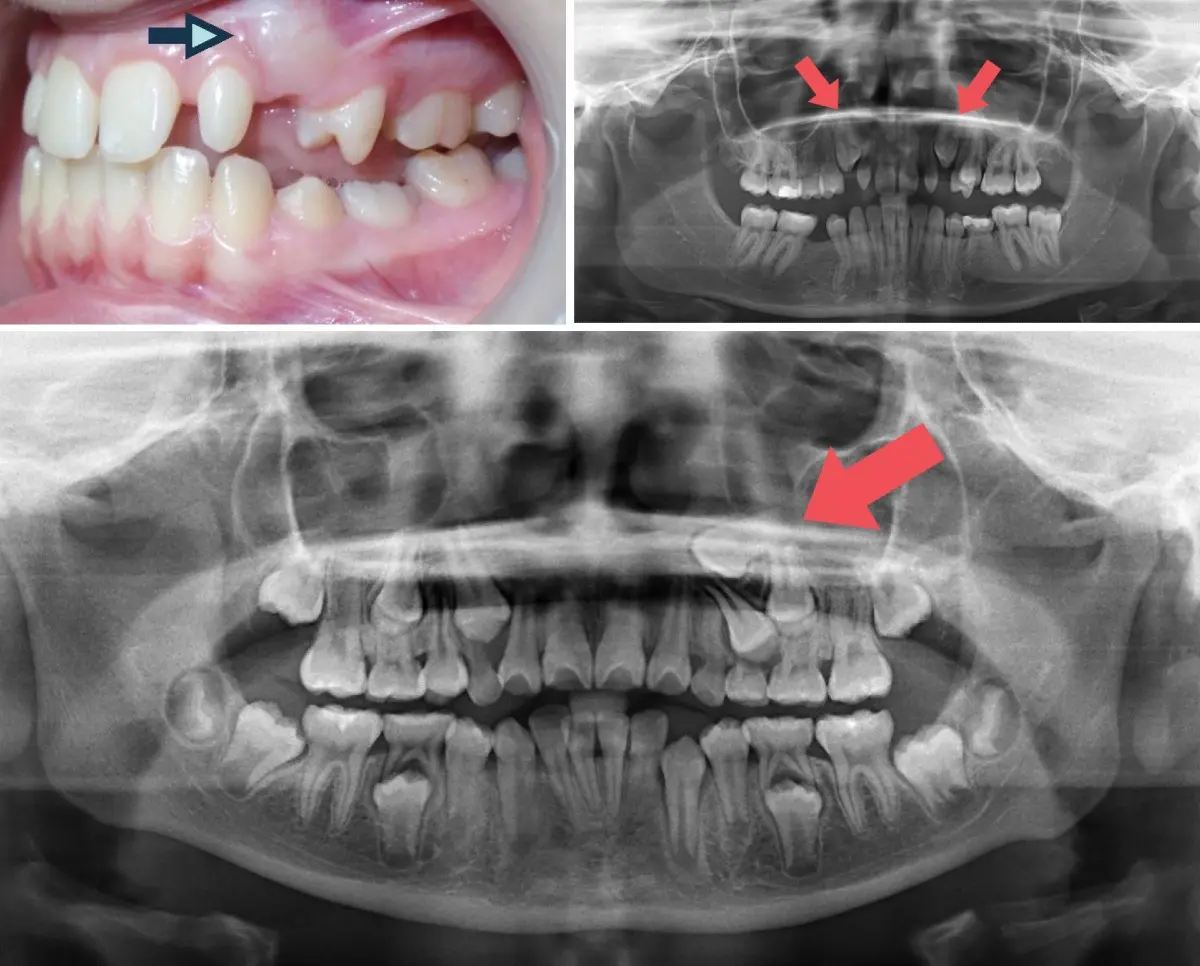  ¿Qué son los dientes impactados? Cómo diagnosticar, métodos de tratamiento y más