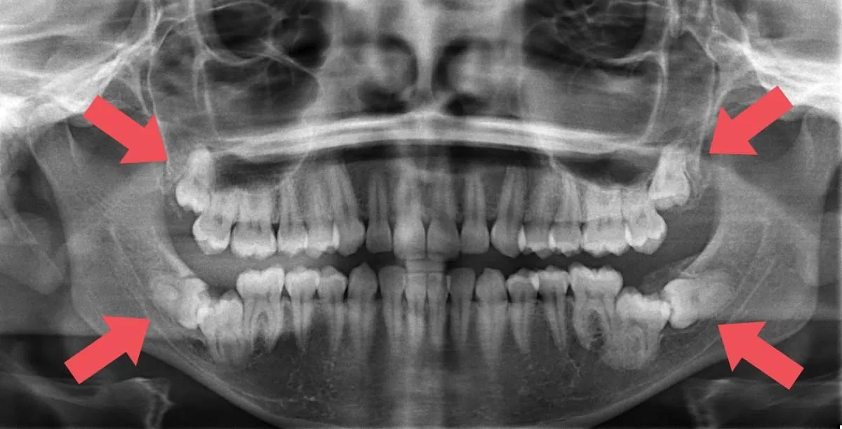 DO  Wisdom Teeth Affect Aligners