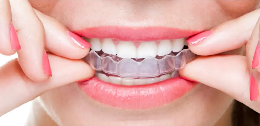 Vivera Retainers Cost: Affordable Dental Solutions Explained
