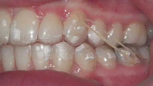 Invisalign with hot sale bands