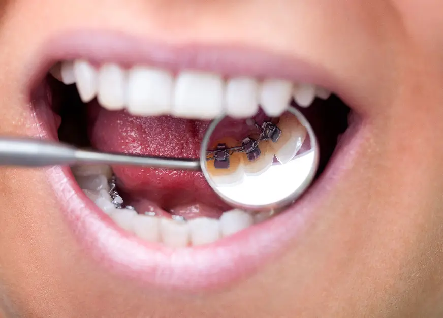 Lingual Braces Components at Orthodontist