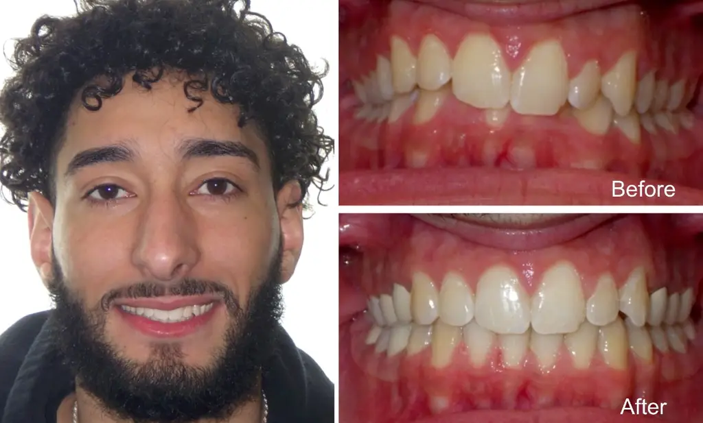 Male  Years Old with Overbite Before and After Invisalign Treatment