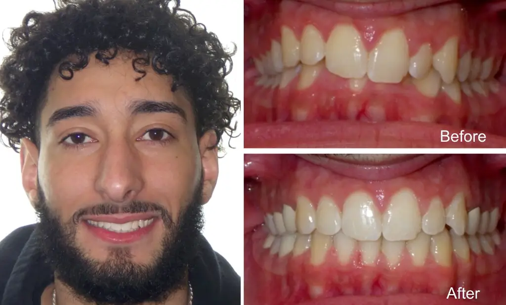 Hombre de 21 años con sobremordida antes y después del tratamiento con Invisalign