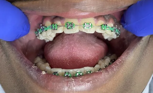 WHAT IS  Metal Braces Materials