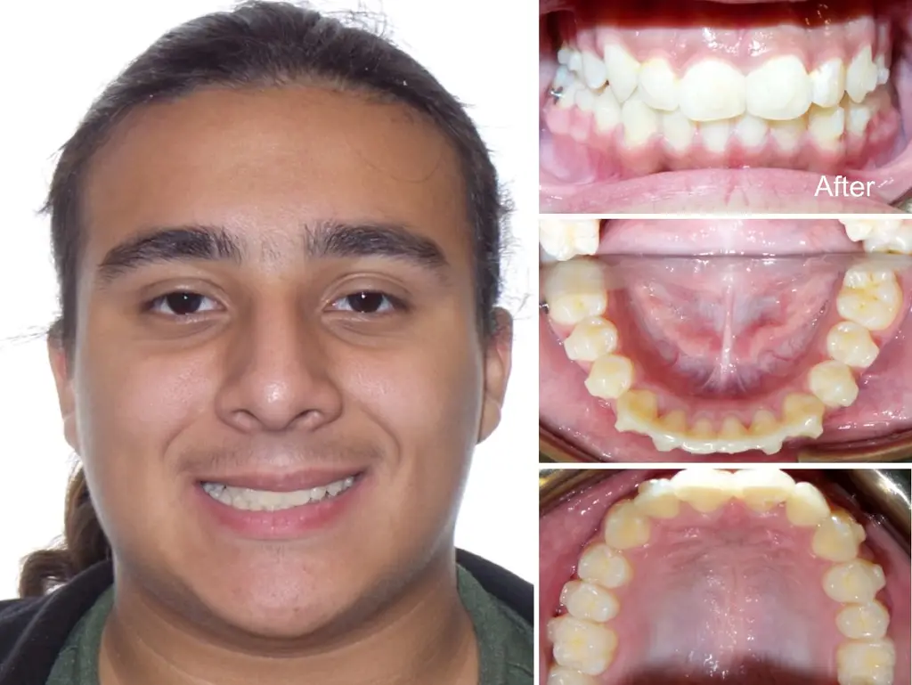 Nataniel  years old Crowding casued by Overbite and Space Deficiency after Invisalign treatment