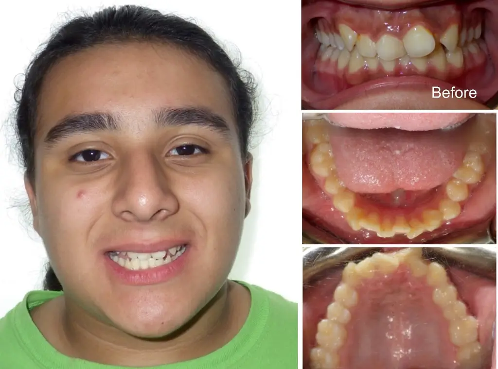 Nataniel  years old Crowding casued by Overbite and Space Deficiency before Invisalign treatment