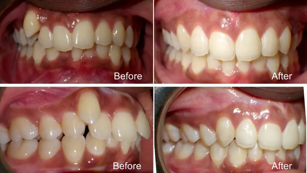 Nia  years old Crowding and Overbite alleviated with extractions and Invisalgn treatment before and after