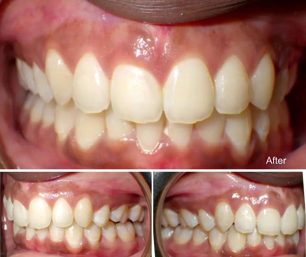Nia  years old extraction case after Invisalign treatment