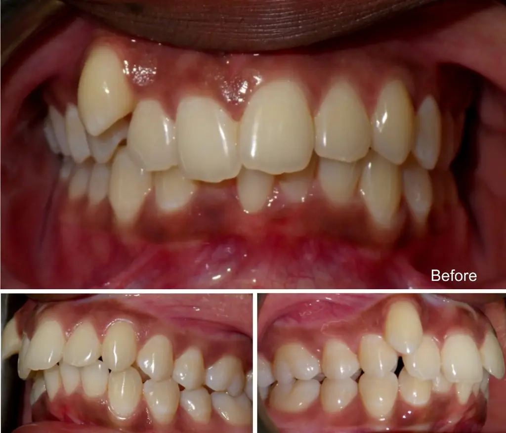 Nia  years old extraction case before Invisalign treatment