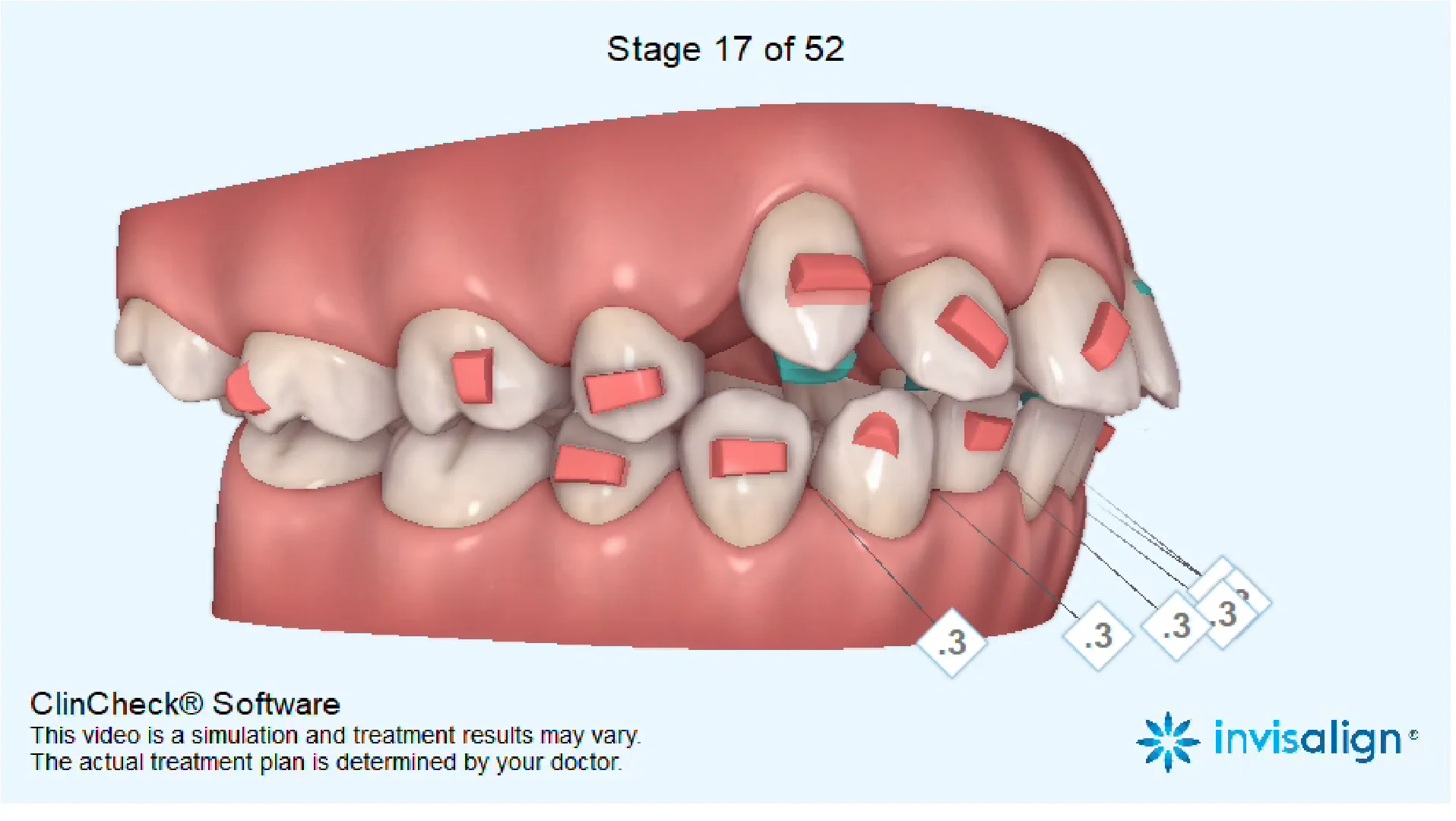 A Simple Breakdown Of The 3 Different Phases Of Orthodontic Treatment , orthodontic treatment