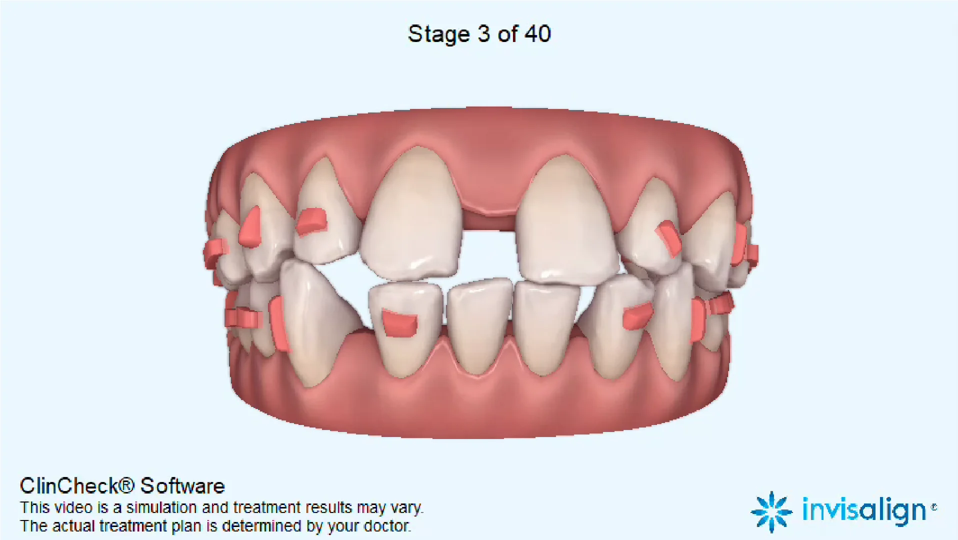 https://resources.diamondbraces.com/?m=Nigel-Before-and-After-Small-Teeth-Spaces-5.webp