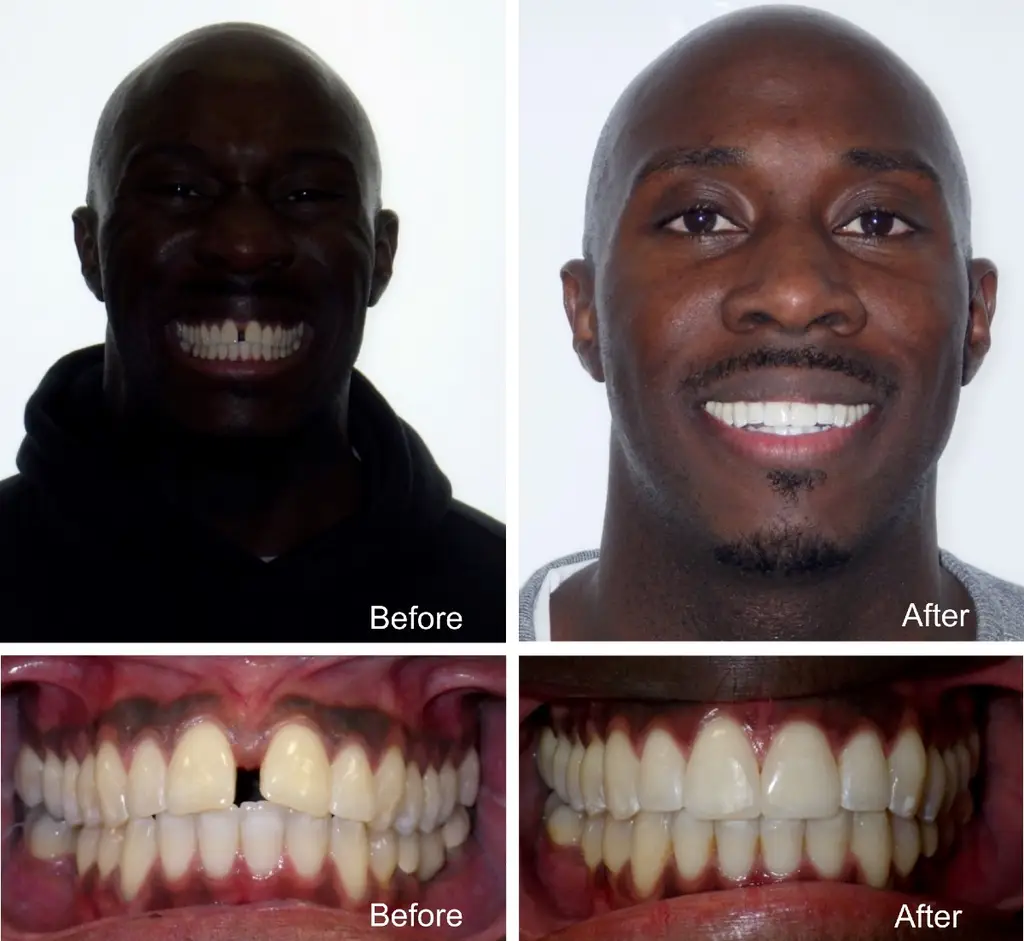 Omar 34 años, cierre de espacios, antes y después del tratamiento con Invisalign