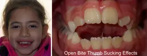 Open Bite Jocelyn Thumb Sucking Effects Open Bite Thumb Sucking Effects