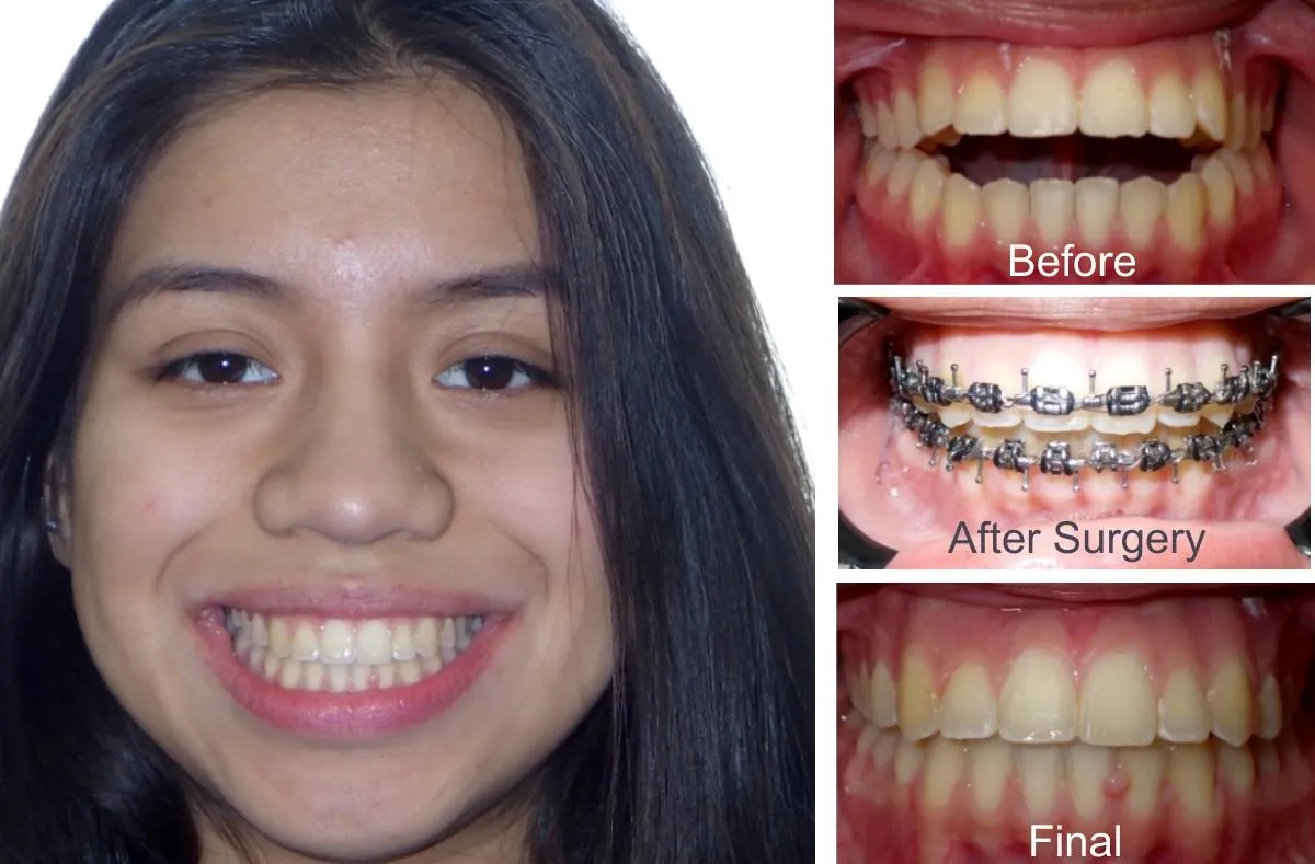 Cirugía Oral para Mordida Abierta Antes y Después