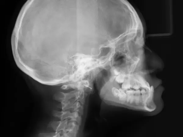 Radiografía ortodóntica de paciente con mordida cruzada