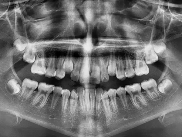 Orthodontic X Ray of Crowding Patient