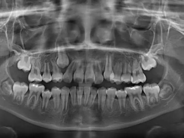 Radiografía ortodóntica de paciente con extracción dental