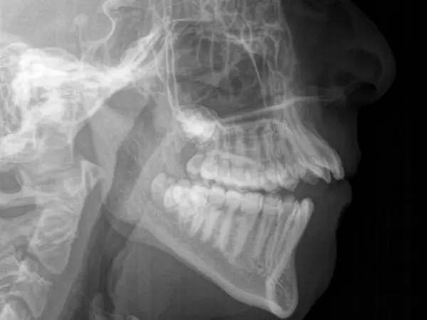 Orthodontic X Ray of Open Bite Patient
