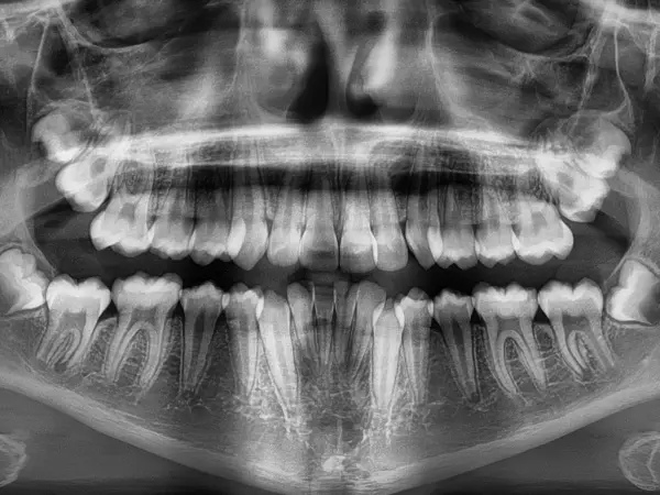 Orthodontic X Ray of Overbite Patient