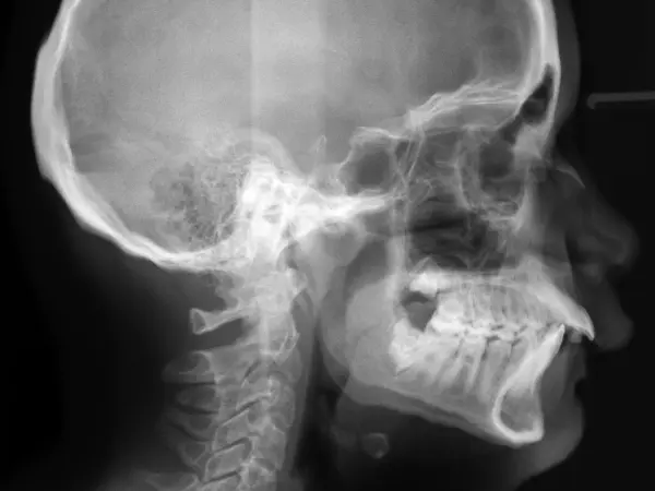 Radiografía ortodóncica de paciente con sobremordida