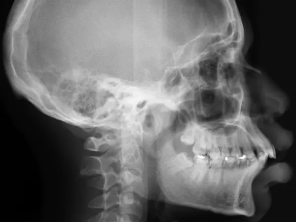 Radiografía ortodóncica de paciente con espacios entre sus dientes