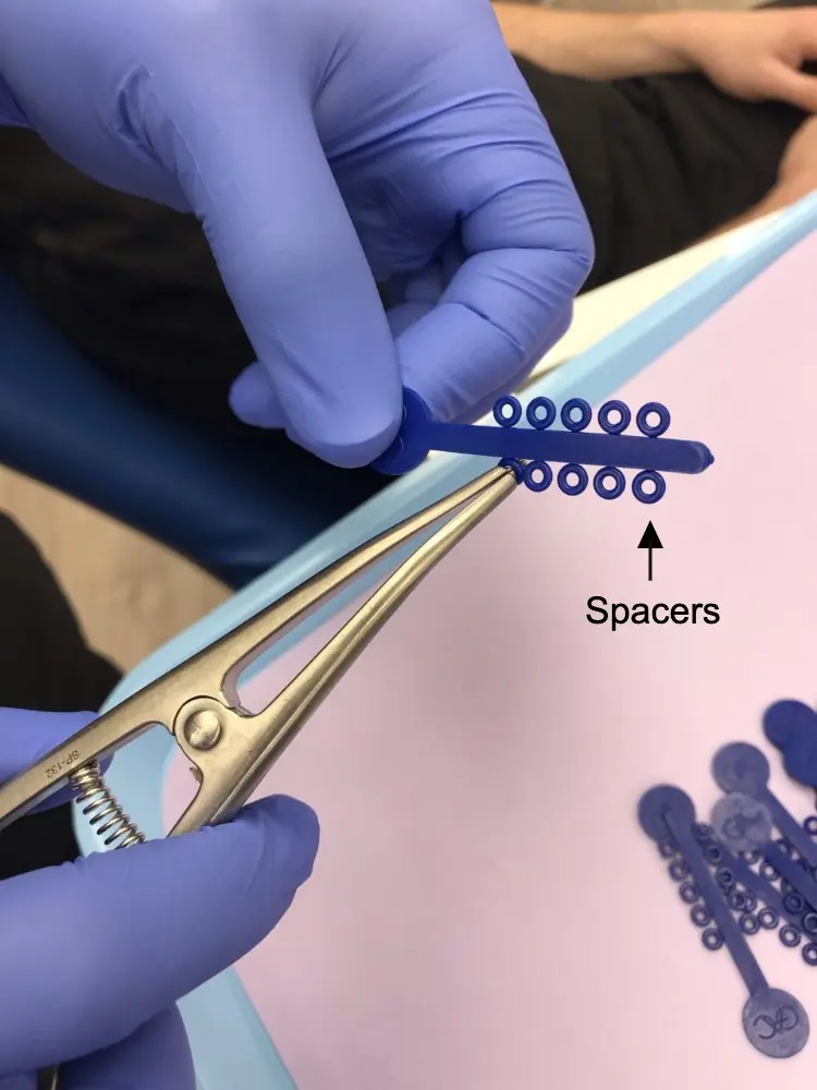Spacers for Braces Guide How They Work, Pain & More