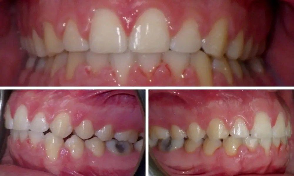 Transform Your Teeth with Clear Aligners: Before and After Pictures