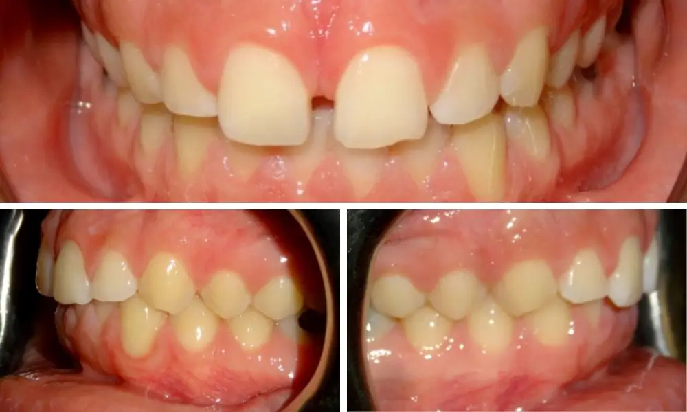 Braces: Before and After Buck Teeth